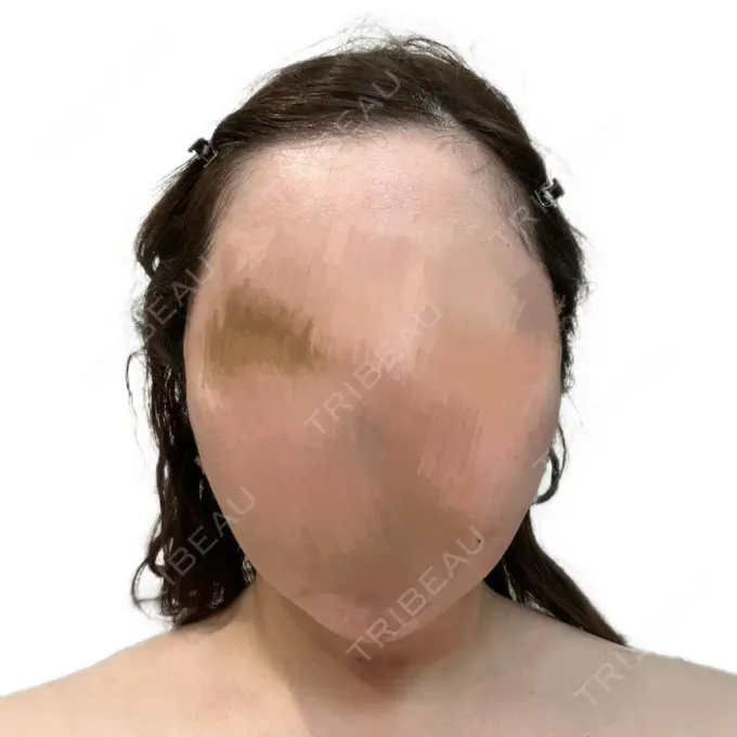 糸リフト / 脂肪吸引（顔） 東京ココセランクリニック AFTER メイン用