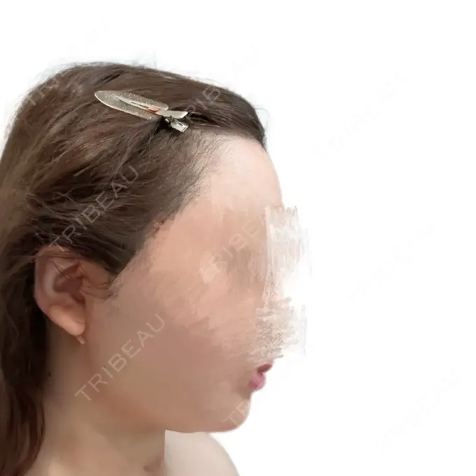 糸リフト / 脂肪吸引（顔） 東京ココセランクリニック DAY 1 メイン用