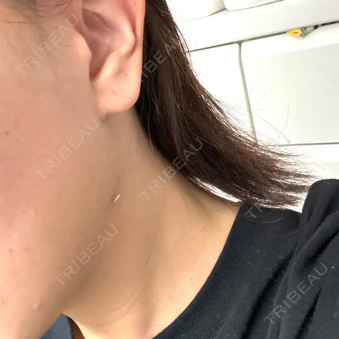 糸リフト / クマ治療 / 脂肪吸引（顔） / ヒアルロン酸注入（涙袋） / ヒアルロン酸注入（唇） ネビュラクリニック 東京錦糸町院 DAY 14 メイン用