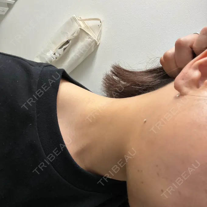 糸リフト / クマ治療 / 脂肪吸引（顔） / ヒアルロン酸注入（涙袋） / ヒアルロン酸注入（唇） ネビュラクリニック 東京錦糸町院 DAY 14 メイン用