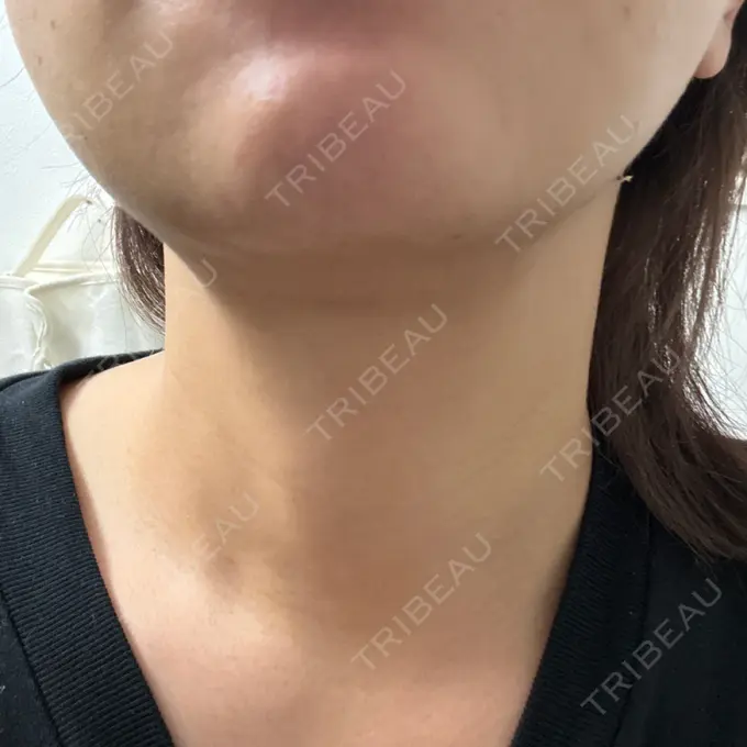 糸リフト / クマ治療 / 脂肪吸引（顔） / ヒアルロン酸注入（涙袋） / ヒアルロン酸注入（唇） ネビュラクリニック 東京錦糸町院 DAY 14 メイン用