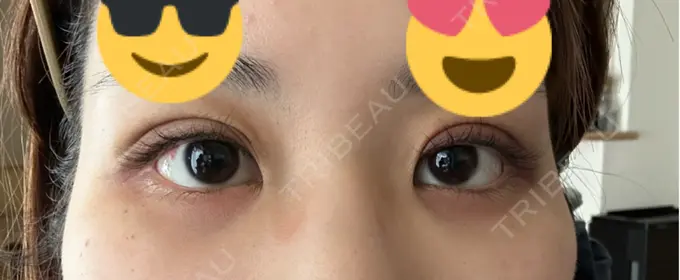 二重埋没 WOM CLINIC GINZA （ワム クリニック ギンザ） DAY 2 メイン用