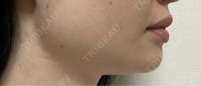 ボトックス（エラ・小顔） TCB東京中央美容外科 自由が丘院 DAY 4 メイン用