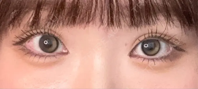 二重埋没 R Beauty CLINIC 銀座院 AFTER メイン用