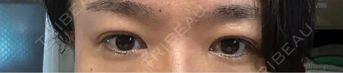 二重埋没 R Beauty CLINIC 銀座院 AFTER メイン用