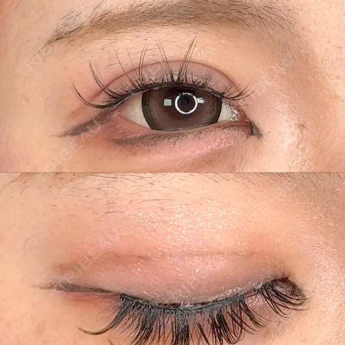 二重埋没 / ボトックス（あご） / ヒアルロン酸注入（あご） / ボトックス（エラ・小顔） アリエル美容クリニック 水戸院 AFTER メイン用