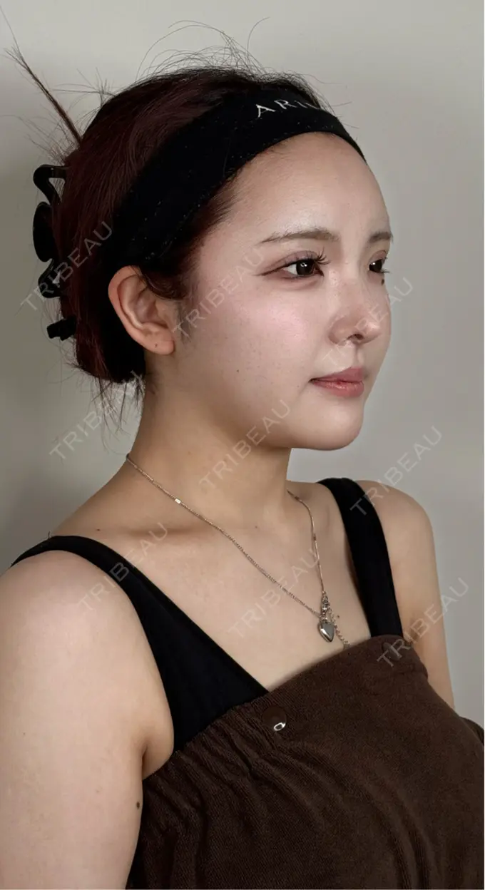 二重埋没 / ボトックス（あご） / ヒアルロン酸注入（あご） / ボトックス（エラ・小顔） アリエル美容クリニック 水戸院 DAY 42 メイン用