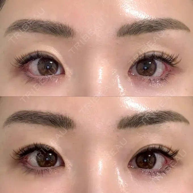 目尻切開 / タレ目形成・グラマラスライン（埋没） LOUIS CLINIC 二子玉川院【ルイクリニック】 DAY 4 メイン用