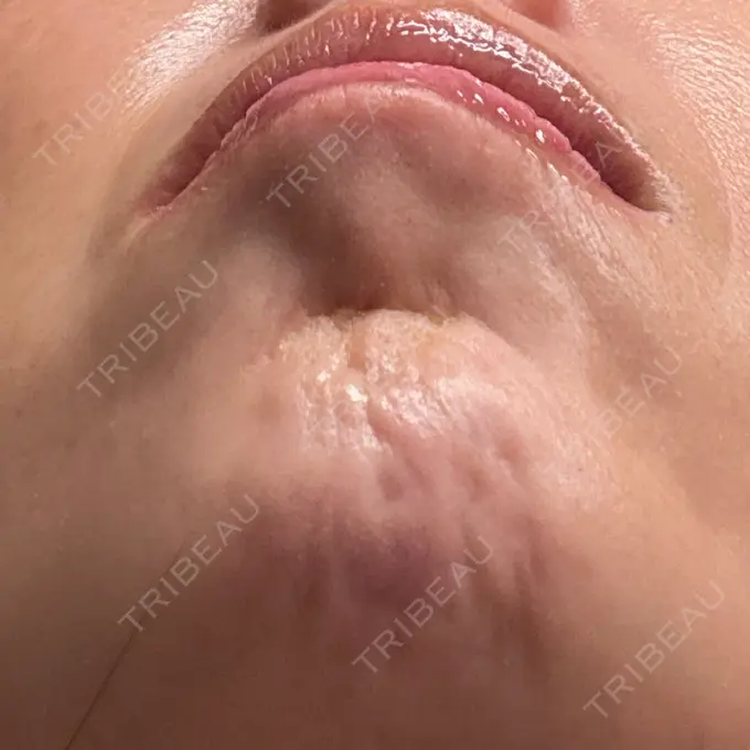 ボトックス（あご） DMTC美容皮膚科 大宮院 DAY 0 メイン用