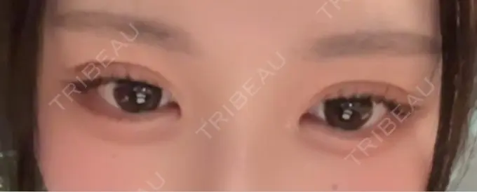 二重埋没 恵聖会クリニック 心斎橋院 DAY 25 メイン用