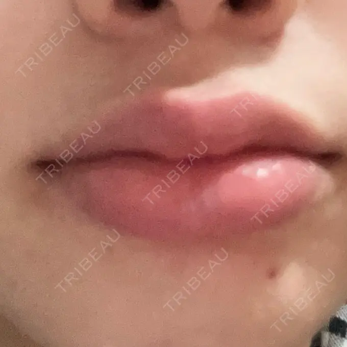 ボトックス（口角） 小倉美容外科/美容皮膚科 ビラビューティークリニック DAY 2 メイン用