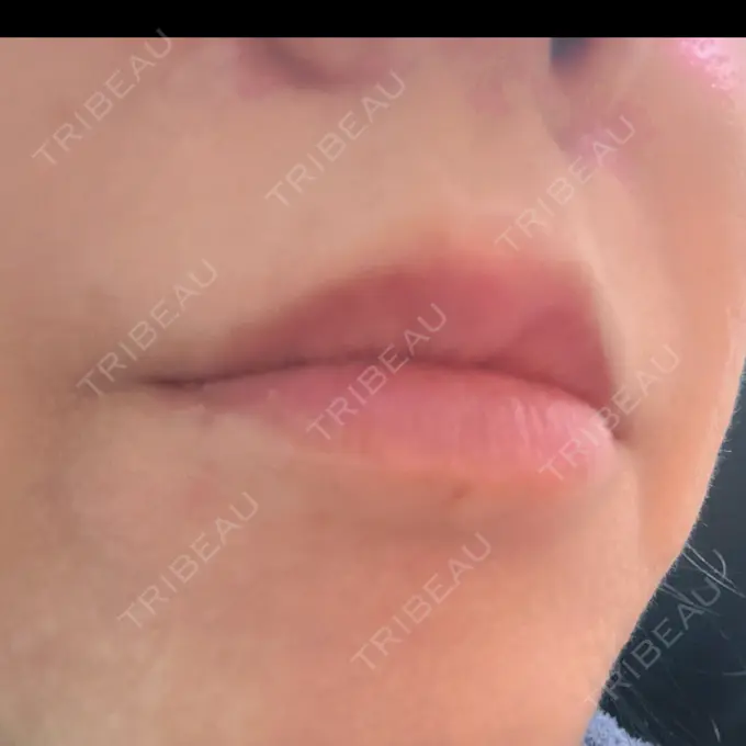 ヒアルロン酸注入（唇） 目白ホワイトクリニック DAY 6 メイン用