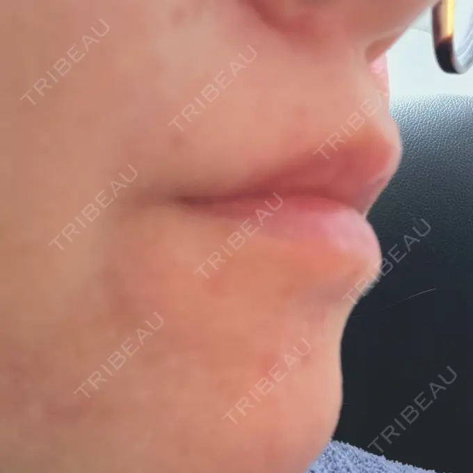 ヒアルロン酸注入（唇） 目白ホワイトクリニック DAY 6 メイン用