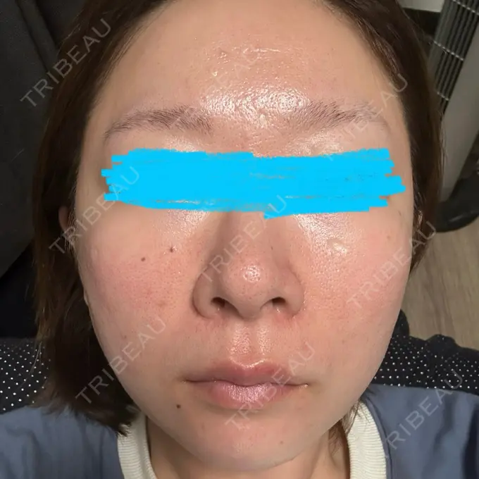 ピーリング（ハリ・ツヤ） / ルメッカ ルラ美容クリニック 名古屋栄院 / ルラスキンクリニック 名古屋栄院 AFTER メイン用