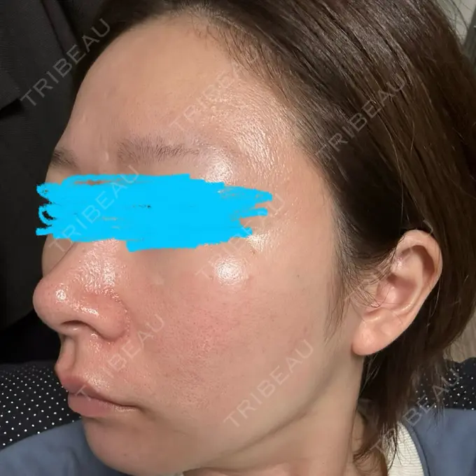 ピーリング（ハリ・ツヤ） / ルメッカ ルラ美容クリニック 名古屋栄院 / ルラスキンクリニック 名古屋栄院 DAY 5 メイン用