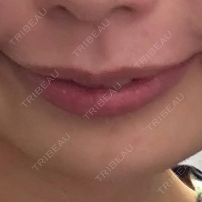 ヒアルロン酸注入（唇） / ヒアルロン酸注入（額） 目白ホワイトクリニック DAY 6 メイン用