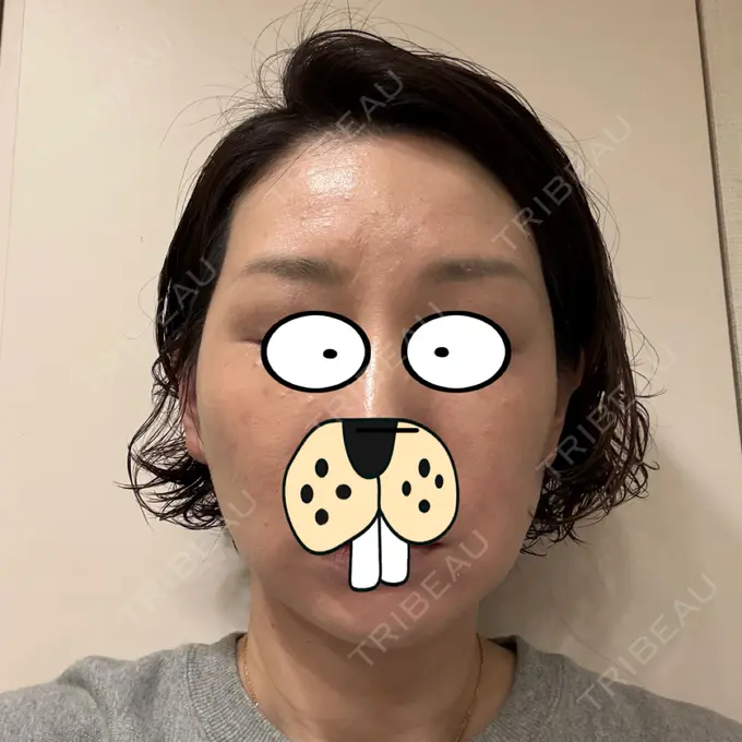 ボトックス（エラ・小顔） / ハイフ（顔） / スネコス LOUIS CLINIC 二子玉川院【ルイクリニック】 AFTER メイン用