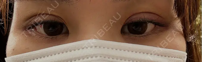 二重埋没 WOM CLINIC GINZA （ワム クリニック ギンザ） DAY 3 メイン用