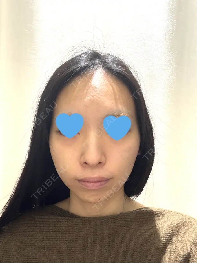 ピーリング（ニキビ・毛穴） / イオン導入 First Clinic DAY 0 メイン用