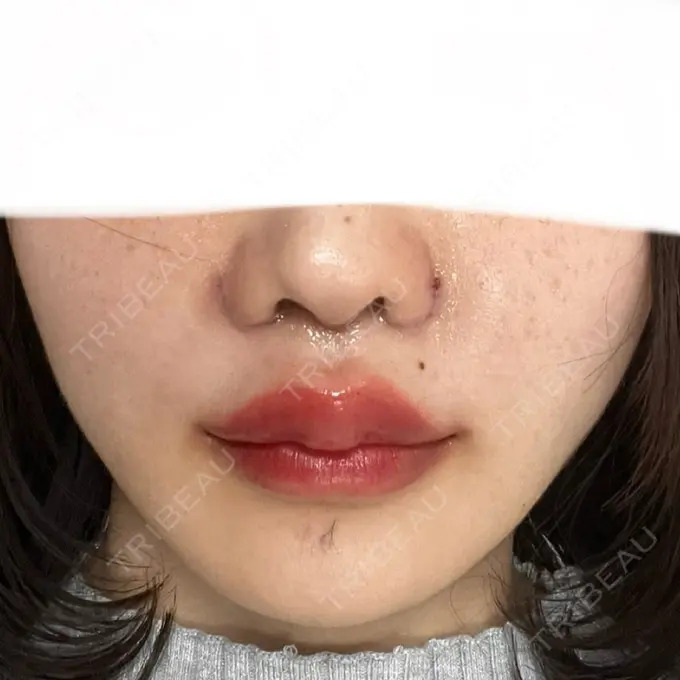 人中短縮 東京美容医療クリニック 池袋院 DAY 4 メイン用