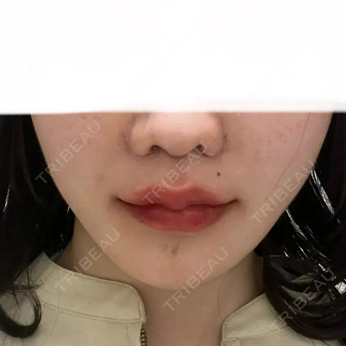 人中短縮 東京美容医療クリニック 池袋院 DAY 5 メイン用