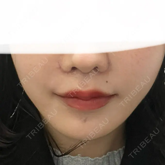 人中短縮 東京美容医療クリニック 池袋院 DAY 7 メイン用