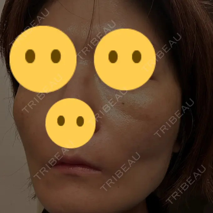 糸リフト SK新宿歌舞伎町美容外科・歯科 DAY 3 メイン用