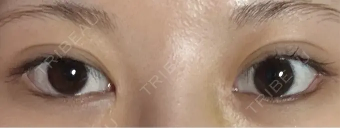 目尻切開 / タレ目形成・グラマラスライン（埋没） LOUIS CLINIC 二子玉川院【ルイクリニック】 DAY 7 メイン用