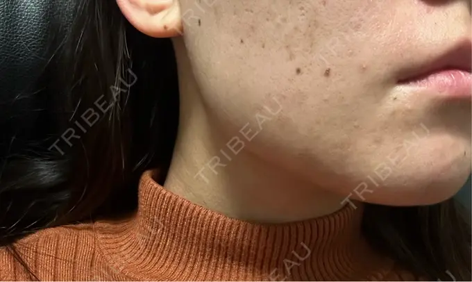 ボトックス（エラ・小顔） フィラークリニック 名古屋栄院 DAY 5 メイン用