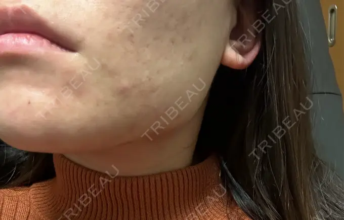 ボトックス（エラ・小顔） フィラークリニック 名古屋栄院 DAY 5 メイン用