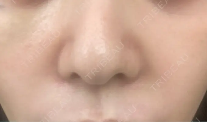 ヒアルロン酸注入（目の下） / ヒアルロン酸注入（鼻翼基部） 湘南美容クリニック 博多院 DAY 3 メイン用