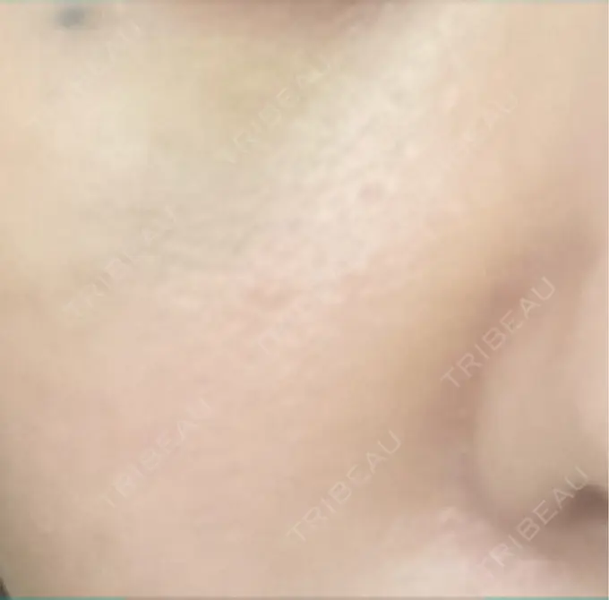 ヒアルロン酸注入（目の下） / ヒアルロン酸注入（鼻翼基部） 湘南美容クリニック 博多院 DAY 3 メイン用