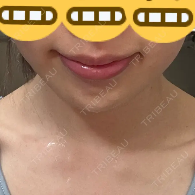 ボトックス（エラ・小顔） / ボトックス（首） DMTC CLINIC 渋谷院 DAY 7 メイン用