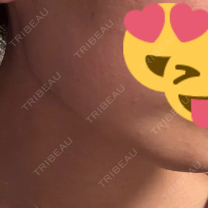 ボトックス（エラ・小顔） / ボトックス（首） DMTC CLINIC 渋谷院 DAY 7 メイン用