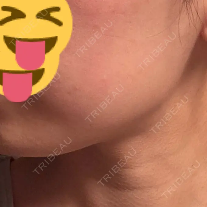 ボトックス（エラ・小顔） / ボトックス（首） DMTC CLINIC 渋谷院 DAY 7 メイン用