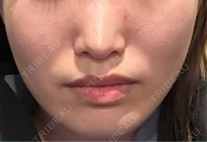 糸リフト / ヒアルロン酸注入（頬） 東京シンデレラ美容外科 池袋院 DAY 4 メイン用