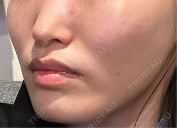 糸リフト / ヒアルロン酸注入（頬） 東京シンデレラ美容外科 池袋院 DAY 4 メイン用