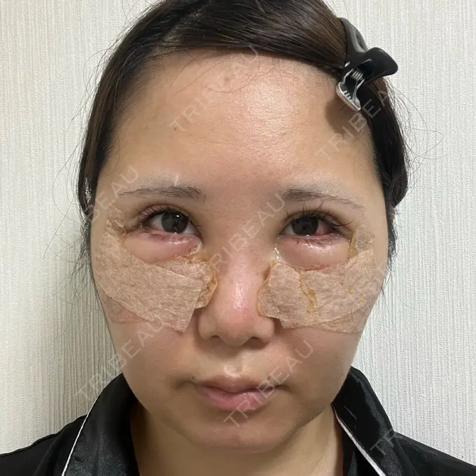 目尻切開 / 脂肪注入（目の下） / その他（目元） WOM CLINIC GINZA （ワム クリニック ギンザ） DAY 1 メイン用