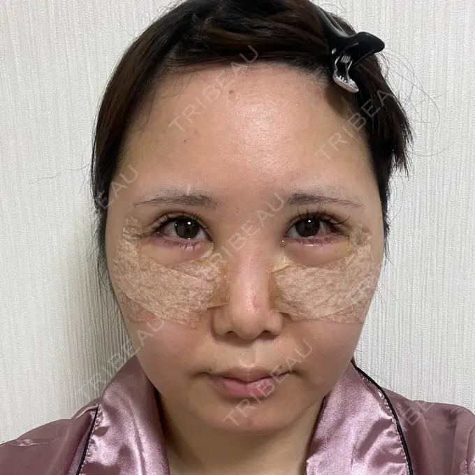 目尻切開 / 脂肪注入（目の下） / その他（目元） WOM CLINIC GINZA （ワム クリニック ギンザ） DAY 2 メイン用