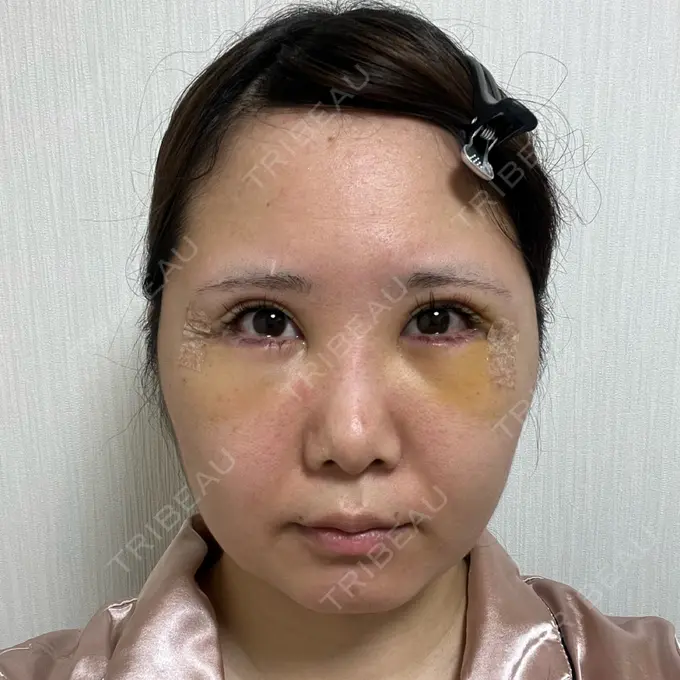 目尻切開 / 脂肪注入（目の下） / その他（目元） WOM CLINIC GINZA （ワム クリニック ギンザ） DAY 4 メイン用