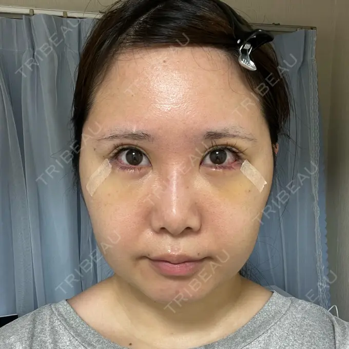 目尻切開 / 脂肪注入（目の下） / その他（目元） WOM CLINIC GINZA （ワム クリニック ギンザ） DAY 6 メイン用