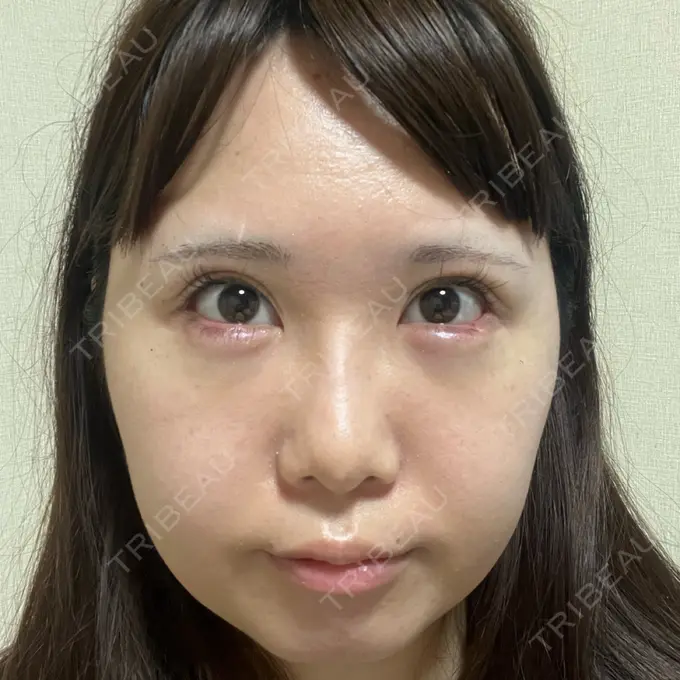 目尻切開 / 脂肪注入（目の下） / その他（目元） WOM CLINIC GINZA （ワム クリニック ギンザ） DAY 11 メイン用