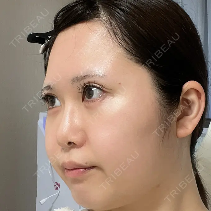 目尻切開 / 脂肪注入（目の下） / その他（目元） WOM CLINIC GINZA （ワム クリニック ギンザ） DAY 34 メイン用