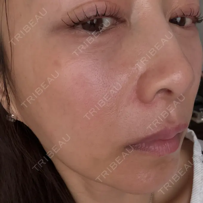 ヒアルロン酸注入（涙袋） / ヒアルロン酸注入（唇） / ヒアルロン酸溶解 / ヒアルロン酸注入（こめかみ） / ヒアルロン酸注入（鼻翼基部） EOL CLINIC【オルクリニック】 AFTER メイン用