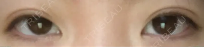 二重埋没 湘南美容クリニック 京都院 DAY 38 メイン用