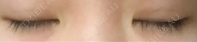 二重埋没 湘南美容クリニック 京都院 DAY 38 メイン用