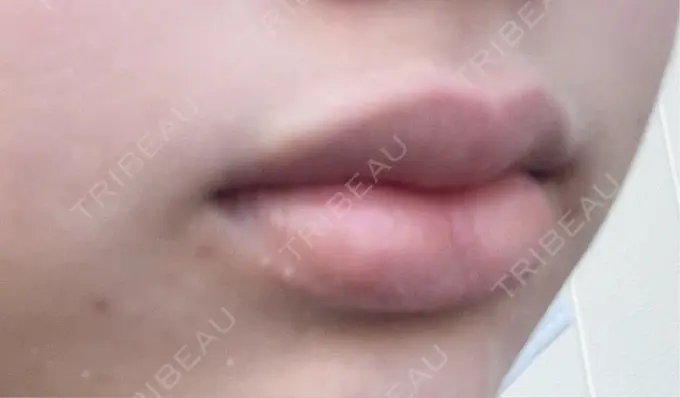 ボトックス（口角） 小倉美容外科/美容皮膚科 ビラビューティークリニック DAY 3 メイン用