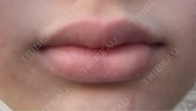 ボトックス（口角） 小倉美容外科/美容皮膚科 ビラビューティークリニック DAY 4 メイン用