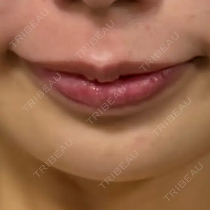 ヒアルロン酸注入（唇） / ヒアルロン酸注入（額） 目白ホワイトクリニック DAY 7 メイン用