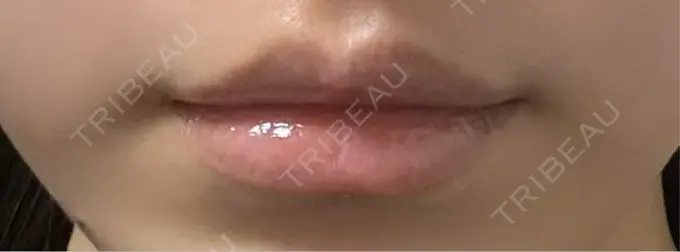 ヒアルロン酸注入（涙袋） / ヒアルロン酸注入（唇） アリエル美容クリニック 横浜院 DAY 4 メイン用